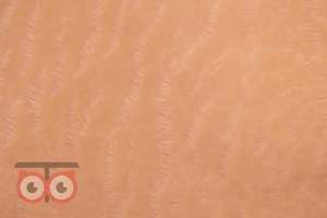 رفع ترک های پوستی با تخفیف ویژه رفع ترک های پوستی با تخفیف ویژه