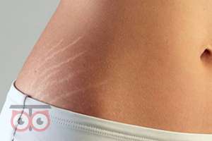 رفع ترک های پوستی با تخفیف ویژه رفع ترک های پوستی با تخفیف ویژه