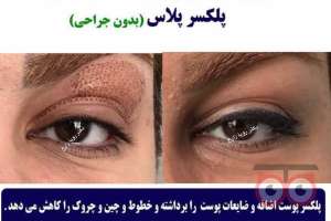 تخفیف ویژه پلکسر تخفیف ویژه پلکسر