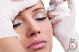 تخفیف ویژه تزریق فیلر تخفیف ویژه تزریق فیلر