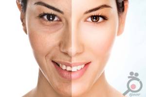 تخفیف ویژه لیزر ND تخفیف ویژه لیزر ND