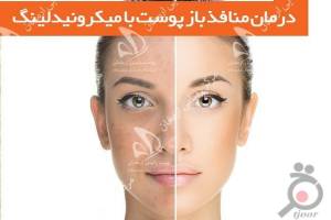 تخفیف ویژه لیزر تخفیف ویژه لیزر