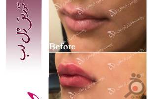 تخفیف ویژه لیزر تخفیف ویژه لیزر