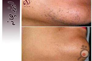 تخفیف ویژه لیزر تخفیف ویژه لیزر