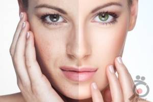 تخفیفات تابستانی بینظیر کلینیک رها تخفیفات تابستانی بینظیر کلینیک رها