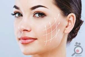 تخفیف هایفو تخفیف هایفو