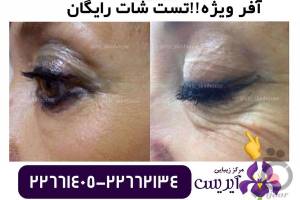 تخفیف ویژه خدمات رفع چروک و جوانسازی تخفیف ویژه خدمات رفع چروک و جوانسازی