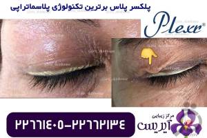 تخفیف ویژه خدمات رفع چروک و جوانسازی تخفیف ویژه خدمات رفع چروک و جوانسازی