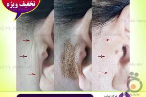 تخفیف ویژه خدمات رفع چروک و جوانسازی تخفیف ویژه خدمات رفع چروک و جوانسازی