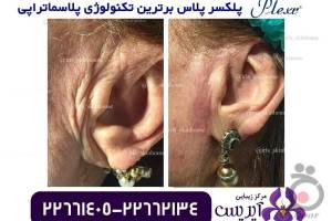 تخفیف ویژه خدمات رفع چروک و جوانسازی تخفیف ویژه خدمات رفع چروک و جوانسازی