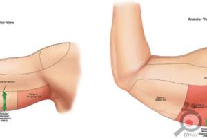 تخفیف ویژه زمستانی جراحی ماستوپکسی تخفیف ویژه زمستانی جراحی ماستوپکسی