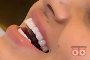 تخفیف ویژه کامپوزیت دندان