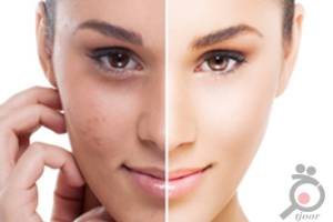 تخفیف ویژه خدمات پوشت و لیزر در کلینیک رها تخفیف ویژه خدمات پوشت و لیزر در کلینیک رها