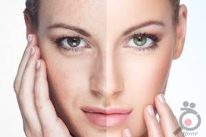 تخفیف ویژه خدمات پوشت و لیزر در کلینیک رها تخفیف ویژه خدمات پوشت و لیزر در کلینیک رها