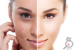 تخفیف ویژه لیزر موهای زائد در کلینیک پوست و لیزر ونوس تخفیف ویژه لیزر موهای زائد در کلینیک پوست و لیزر ونوس