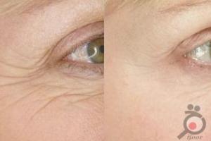 تخفیف ویژه لیزر موهای زائد در کلینیک پوست و لیزر ونوس تخفیف ویژه لیزر موهای زائد در کلینیک پوست و لیزر ونوس