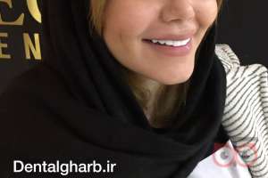 تخفیف ویژه کامپوزیت دندان تخفیف ویژه کامپوزیت دندان