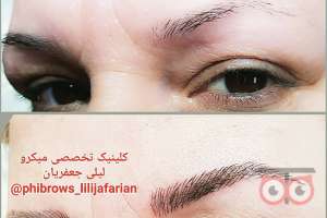 تخفیف ویژه خدمات میکروپیگمنتیشن تخفیف ویژه خدمات میکروپیگمنتیشن