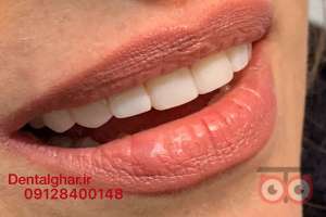 تخفیف ویژه کامپوزیت دندان تخفیف ویژه کامپوزیت دندان