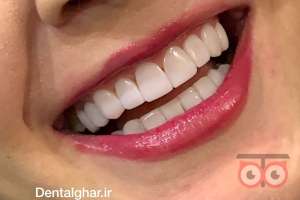 تخفیف ویژه کامپوزیت دندان