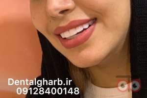 تخفیف ویژه کامپوزیت دندان تخفیف ویژه کامپوزیت دندان