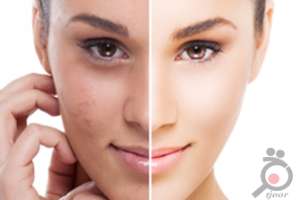 تخفیف زمستانی خدمات زیبایی و درمانی کلینیک ستاره فرهنگ تخفیف زمستانی خدمات زیبایی و درمانی کلینیک ستاره فرهنگ