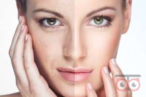 تخفیف ویژه انواع خدمات زیبایی شامل: فیلر ، بوتاکس، لیزر، میکروبیلدینگ، مزوتراپی تخفیف ویژه انواع خدمات زیبایی شامل: فیلر ، بوتاکس، لیزر، میکروبیلدینگ، مزوتراپی