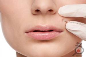 تخفیف ویژه تزریق فیلر تخفیف ویژه تزریق فیلر