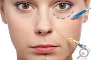 تخفیف ویژه تزریق فیلر تخفیف ویژه تزریق فیلر