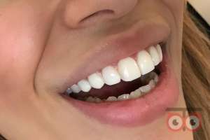 تخفیف کامپوزیت ونیر دندان