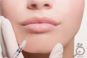 تخفیف تزریق ژل آلمانی تخفیف تزریق ژل آلمانی