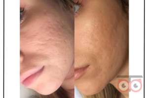 تخفیف ویژه خدمات زیبایی کلینیک دریتا تخفیف ویژه خدمات زیبایی کلینیک دریتا