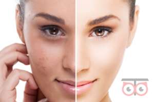 تخفیف ویژه لیزر موهای زائد تخفیف ویژه لیزر موهای زائد