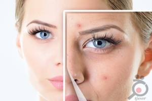 تخفیف درمان لک و جای جوش تخفیف درمان لک و جای جوش