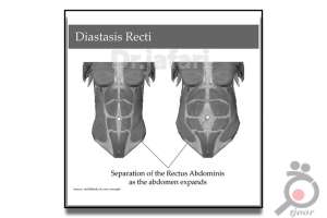 تخفیف ویژه لیپوماتیک تخفیف ویژه لیپوماتیک