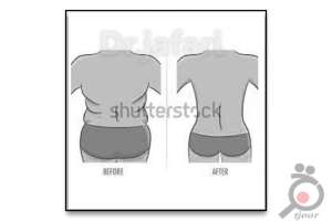 تخفیف ویژه لیپوماتیک تخفیف ویژه لیپوماتیک