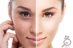 تخفیف ویژه فشیال و پاکسازی صورت تخفیف ویژه فشیال و پاکسازی صورت