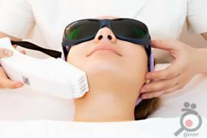 تخفیف ویژه لیزر موهای زائد تخفیف ویژه لیزر موهای زائد