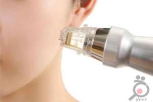 تخفیف میکرونیدلینگ تخفیف میکرونیدلینگ