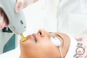 تخفیف ویژه لیزر موهای زائد تخفیف ویژه لیزر موهای زائد