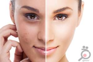 تخفیف ویژه پلاسما جت تخفیف ویژه پلاسما جت