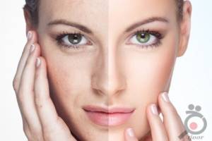 تخفیف رفع چین و چروک پلک و صورت تخفیف رفع چین و چروک پلک و صورت