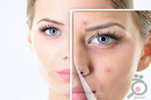 تخفیف ویژه رفع جای لک و اسکار با دستگاه تیکسل تخفیف ویژه رفع جای لک و اسکار با دستگاه تیکسل