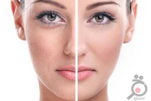 تخفیف ویژه رفع جای لک و اسکار با دستگاه تیکسل تخفیف ویژه رفع جای لک و اسکار با دستگاه تیکسل