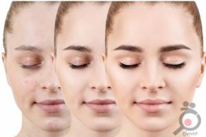 تخفیف ویژه رفع جای لک و اسکار با دستگاه تیکسل تخفیف ویژه رفع جای لک و اسکار با دستگاه تیکسل