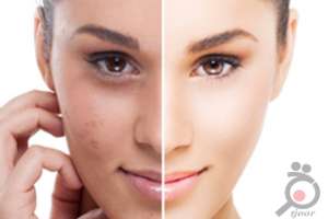 تخفیف ویژه پاکسازی بوسیله اسکوم تراپی تخفیف ویژه پاکسازی بوسیله اسکوم تراپی