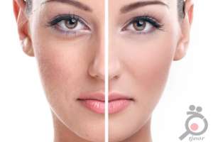 تخفیف ویژه پاکسازی بوسیله اسکوم تراپی تخفیف ویژه پاکسازی بوسیله اسکوم تراپی