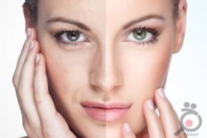 تخفیف ویژه رفع چروک دور چشم و جوانسازی دور چشم تخفیف ویژه رفع چروک دور چشم و جوانسازی دور چشم