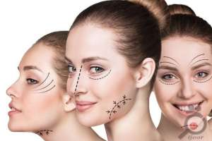 تخفیف ویژه عمل لیفت صورت تخفیف ویژه عمل لیفت صورت