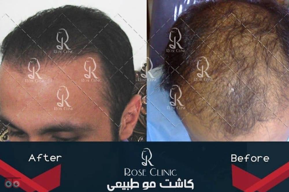 تخفیف ویژه کاشت مو تخفیف ویژه کاشت مو